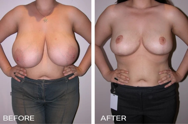 Case Study of Breast Reduction Mammoplasty Surgery #1 1 Breast Reduction Before and After