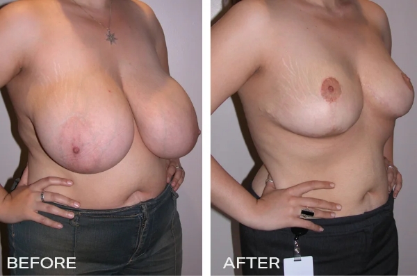 Case Study of Breast Reduction Mammoplasty Surgery #1 2 Large Breast Surgery - Breast Reduction Surgery Image