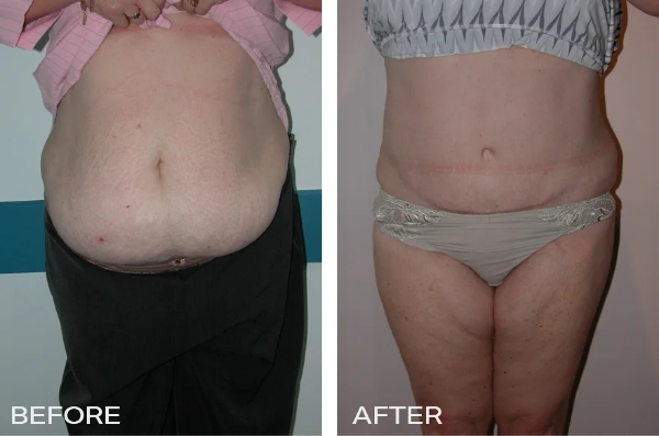Tummy Tuck/ Abdominoplasty Case Study #1 1 Tummy-Tuck-Front