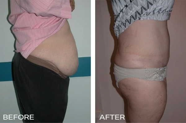 Tummy Tuck/ Abdominoplasty Case Study #1 2 Tummy Tuck Side - Dr Jeremy Hunt