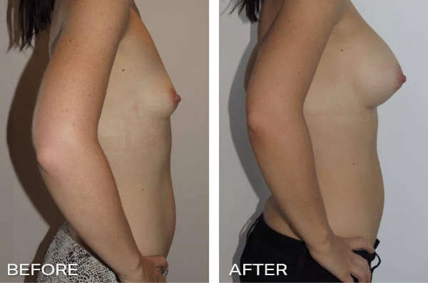 Case Study of Breast Augmentation Mammoplasty # 1 3 Before and After Front - Case Study of Breast Enlargement Dr Jeremy Hunt