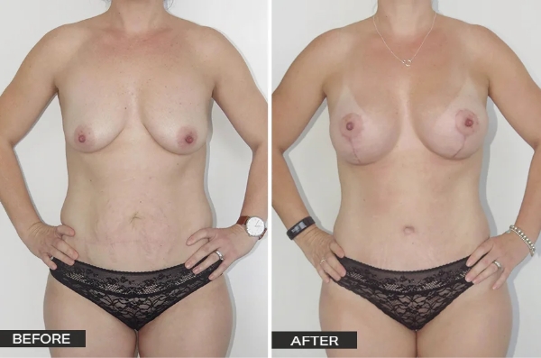 Breast Mastopexy with Augmentation Mammoplasty (Lift with Implants) Surgery Patient – Case Study 4 Case Study Saggy Breasts Before and After - Dr Hunt