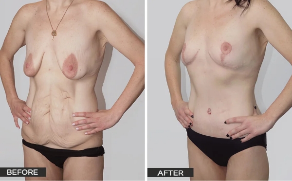 Breast Mastopexy with Augmentation Mammoplasty (Lift with Implants) Surgery Patient – Case Study 2 Breast Lift with Implants Before and After - Dr Jeremy Hunt
