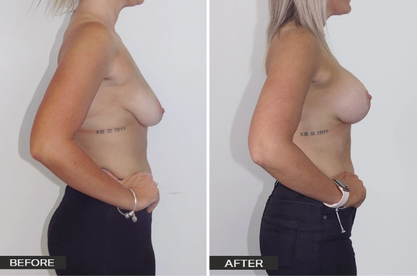 Breast Mastopexy with Augmentation Mammoplasty (Lift with Implants) Surgery Patient – Case Study 1 Breast Lift with Implants Patient Before and After Image Side