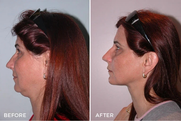 Case Study of Neck Liposuction #1 1 Neck Liposuction Before and After by Dr Jeremy Hunt - Case Study of Heavy Neck