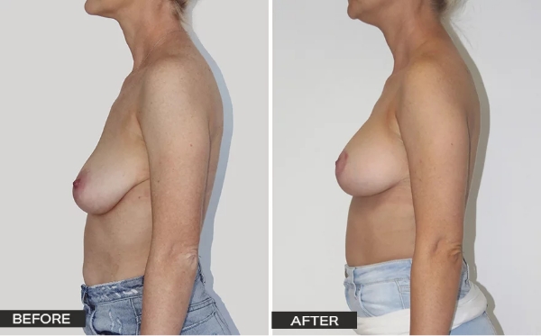 Breast Mastopexy with Augmentation Mammoplasty (Lift with Implants) Surgery Patient – Case Study 3 Case Study Saggy Breasts - Dr Hunt
