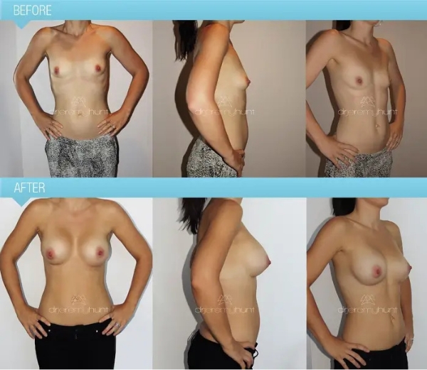 Case Study of Breast Augmentation Mammoplasty # 2 1 Dr Jeremy Hunt - Case Study Bilateral Breast Augmentation Scaled