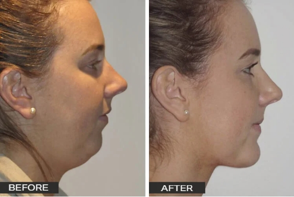 Chin Surgery Case Studies Dr Jeremy Hunt - Chin_2_Side-e1590625600885_edited