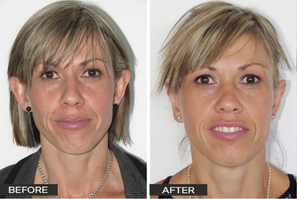 Ear Surgery Otoplasty Case Study 1 Ear Surgery by Dr Jeremy Hunt Before and After Image Ear Surgery 14 Edited Scaled