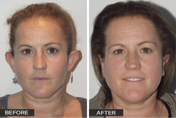 Ear Surgery Otoplasty Case Study 2 Ear Surgery by Dr Jeremy Hunt Before and After Image Ear Surgery 5 Front Scaled