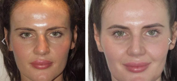 different Types of Noses - Post Traumatic Rhinoplasty - Dr Jeremy Hunt Leading face surgeon