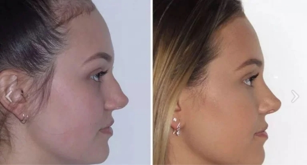 turned-up nose types sydney - Dr Jeremy Hunt Leading face surgeon