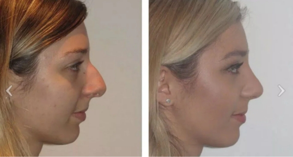 Different Nose Shapes - Combo Nose - Dr Jeremy Hunt Leading face surgeon