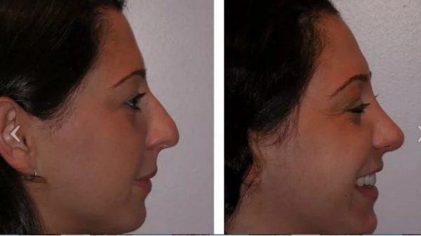 Nixon Nose types - Dr Jeremy Hunt Leading face surgeon