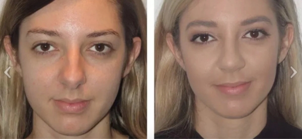 Different Nose Shapes - Dr Jeremy Hunt Leading face surgeon