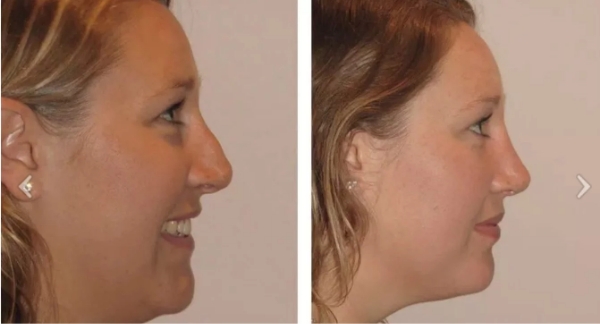 bumpy - Dr Jeremy Hunt Leading face surgeon