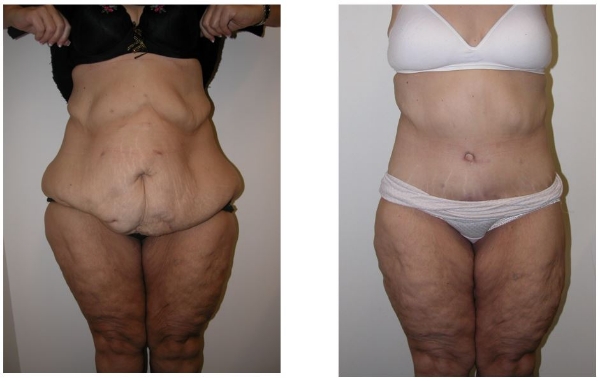 butt augmentation - empty buttlock syndrome - Dr Hunt