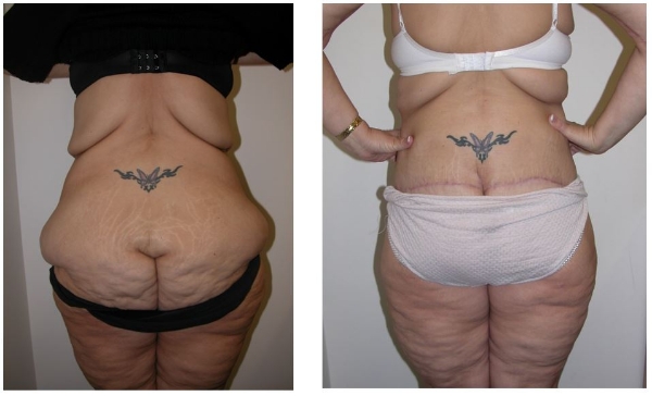 butt augmentation - empty buttlock syndrome - Dr Hunt