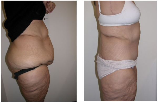 butt augmentation - empty buttlock syndrome - Dr Hunt