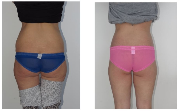 Body Lif with Butt Augmentation Dr Hunt