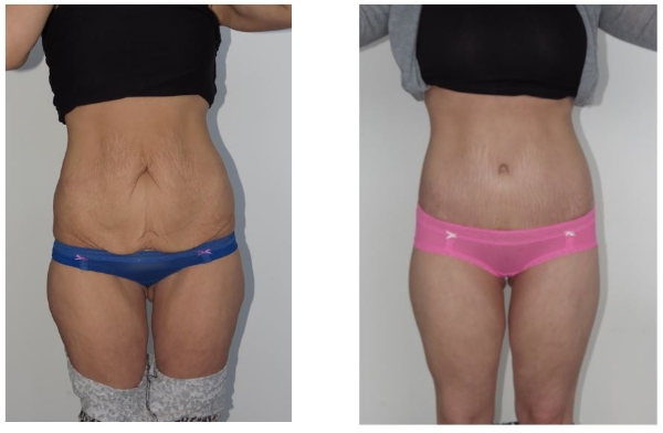 Body Lif with Butt Augmentation Dr Hunt