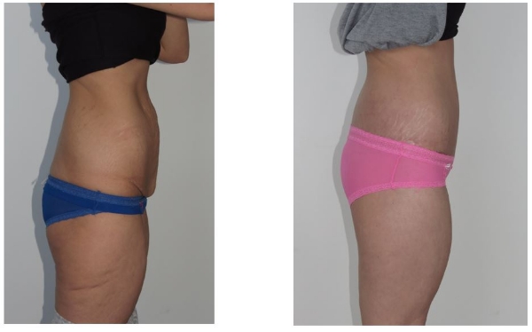 Body Lift Patient With Buttock Augmentation Flap Sydney Dr Hunt
