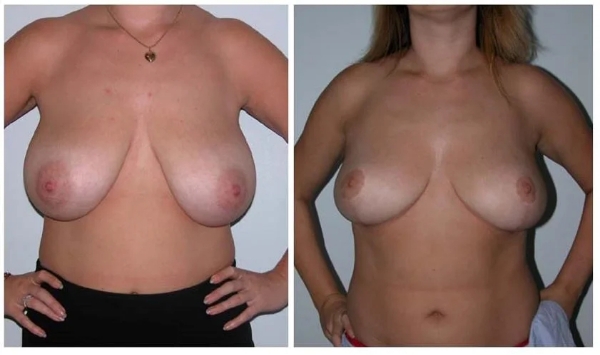 internal bra - How is it performed - Dr Hunt Sydney