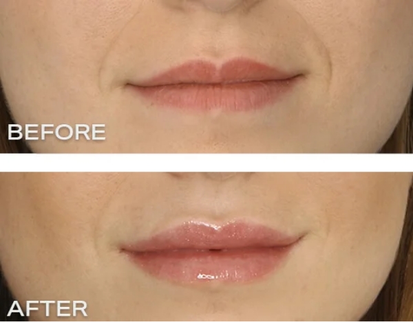 filler 2 1 Things to Avoid after Lip Injections – The Dos & Don’ts of Lip Injections - 1