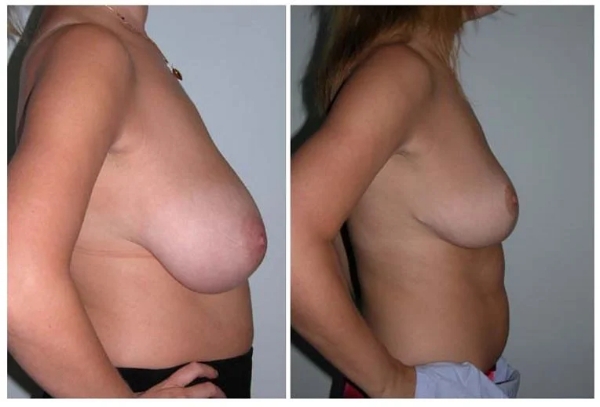 internal bra - How is it performed - Dr Hunt