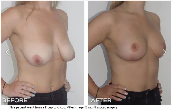 Sydney Internal Bra Lift Dr Hunt