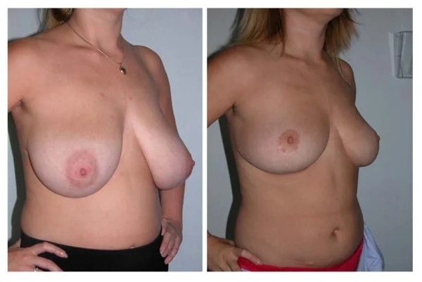 internal bra - how is it performed - Dr Hunt
