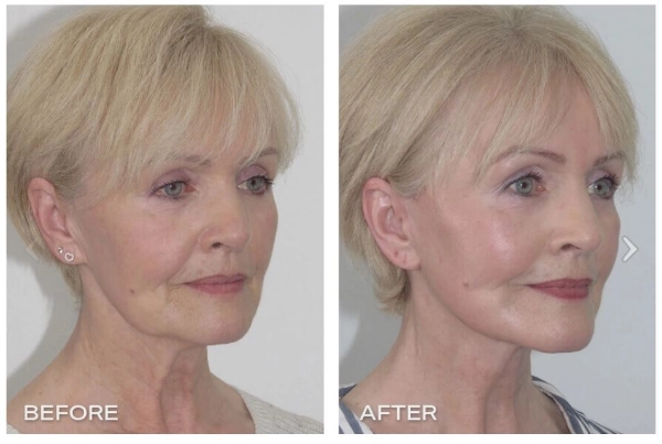 What is the Difference Between a Neck Lift (Platysmaplasty) or Lower Facelift (Rhytidectomy) Surgery? 1 What is neck lift or lower facelift - Dr Jeremy Hunt Leading Plastic Surgeon Sydney NSW