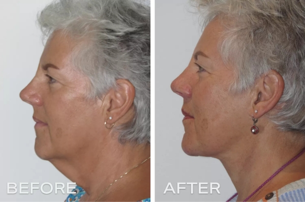 What is the Difference Between a Neck Lift (Platysmaplasty) or Lower Facelift (Rhytidectomy) Surgery? 2 What is neck lift or lower facelift - Dr Jeremy Hunt Leading Plastic Surgeon Sydney NSW